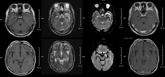 30岁小伙长期熬夜智力退回3岁 年轻人患“脑膜炎”病例为何频发
