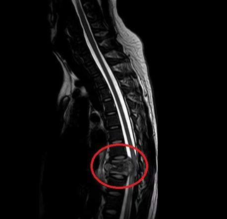 每天泡网吧十几个小时,沉迷于网络游戏的他逐渐直不起腰差点瘫痪