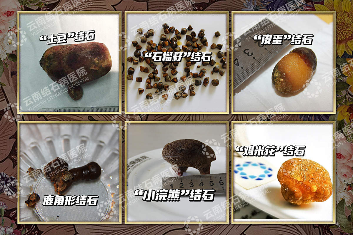 云南肾结石医院：三战结石！当地医生摇头放弃，我院为红河阿姨卸下“石”压重负