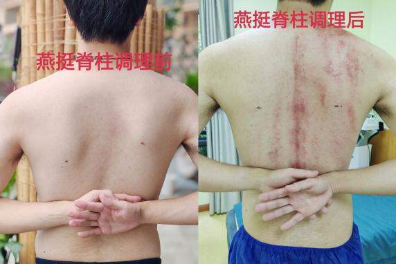 青少年脊柱守护行动——挺起少年脊梁