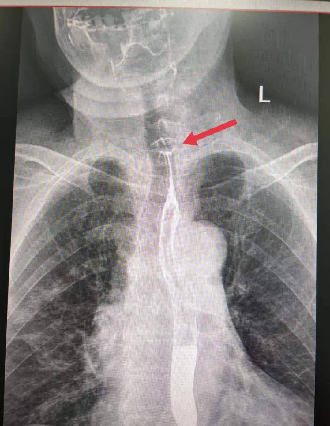 好吃却可能惹出大麻烦 警惕粽子里的“隐形刺客”