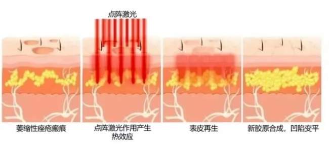 祛痘别只消表面炎症！海峡张光泽研创痘全净：分型分阶，先治痘再重建皮肤屏障