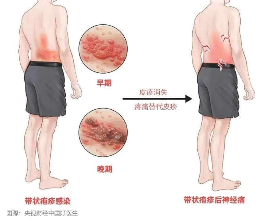 女子拆快递后揉眼睛确诊带状疱疹 预防小贴士请查收