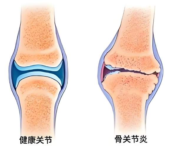 氨糖软骨素钙片能治疗骨关节炎吗？这篇深入讲解！