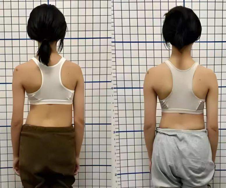 青少年脊柱守护行动——挺起少年脊梁