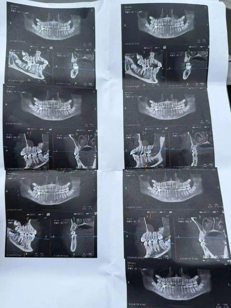 17岁女生实习时晕倒摔断4颗牙 8万多医疗费由谁承担?