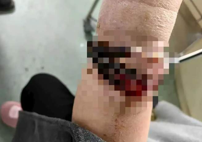 女子手镯10年没摘竟“长”进肉里！医生：再迟就保不住了