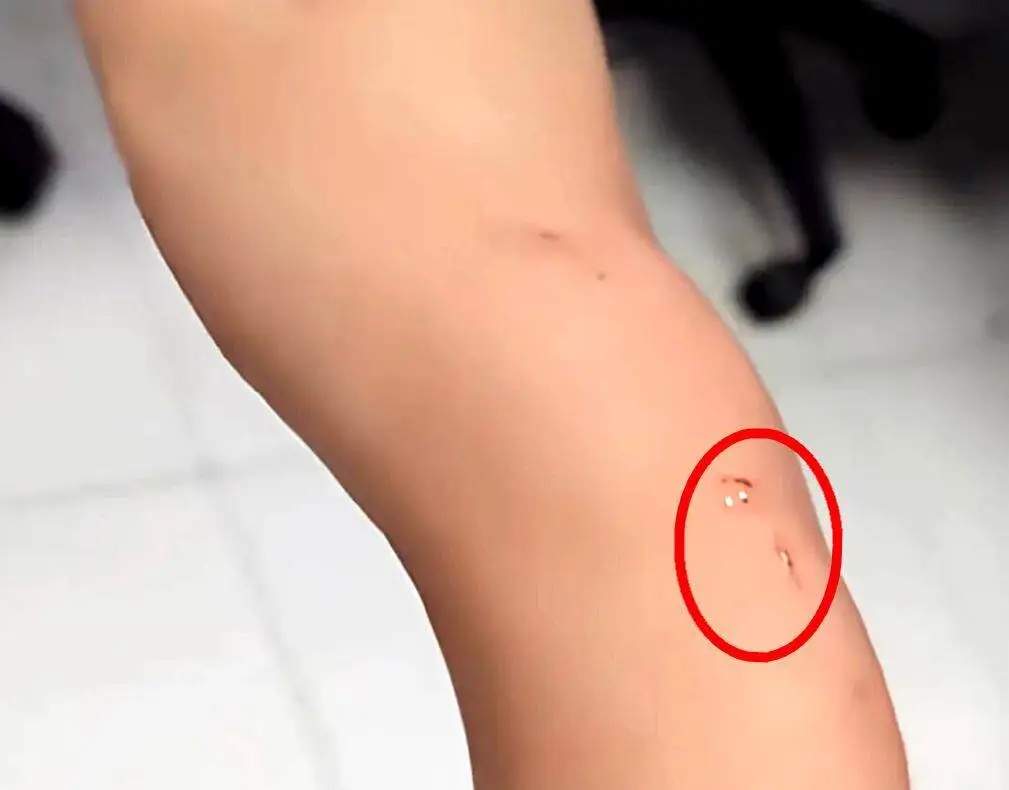 家中闯入“不速之客” 女生徒手抓蝙蝠被咬伤 花1700打疫苗