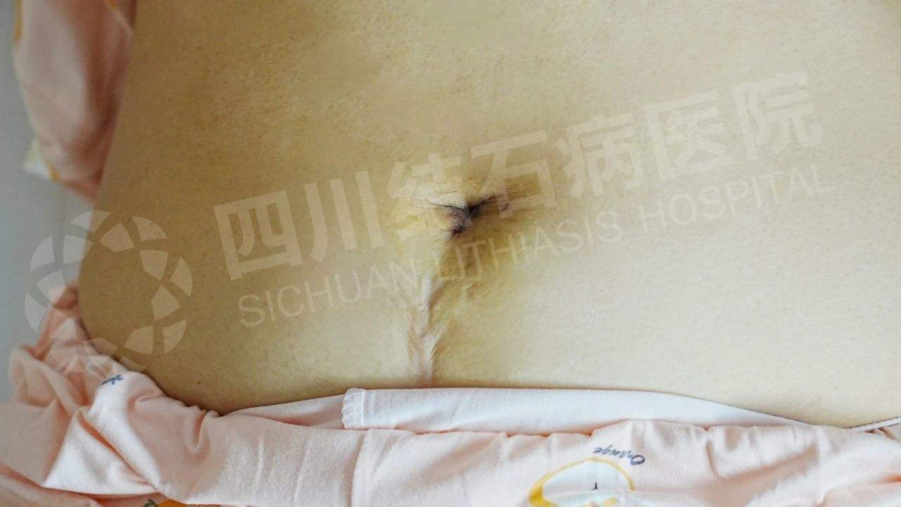 胆结石手术告别“切胆”与“留疤”！经脐隐瘢痕实现无痕保胆【四川结石病医院】