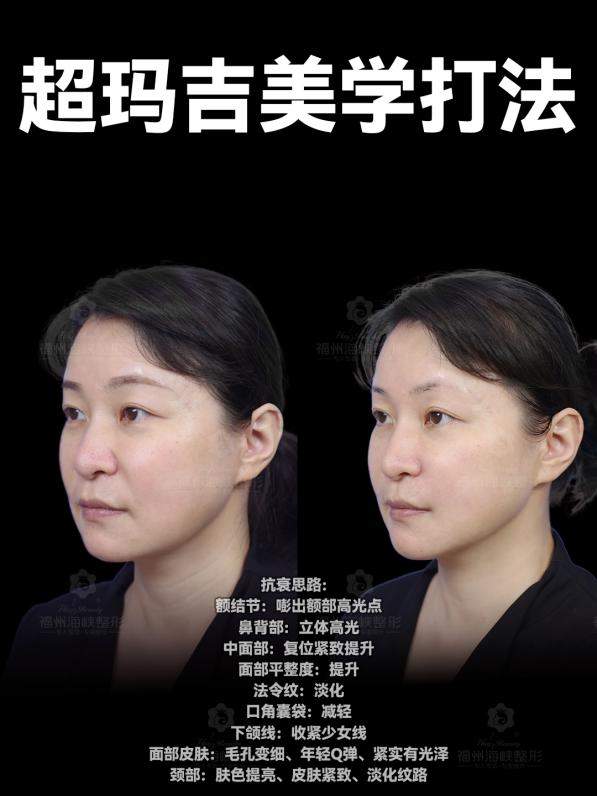 福州联合抗衰如何选？福州海峡林智斌全龄热玛吉联合方案，击破复合衰老难题