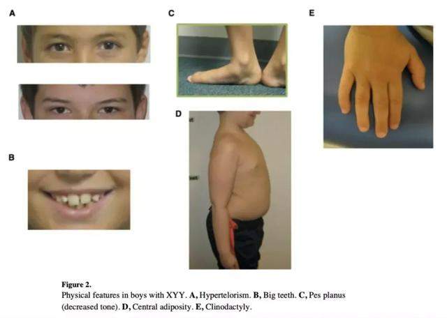 超雄综合征是啥病?不要妖魔化超雄综合征