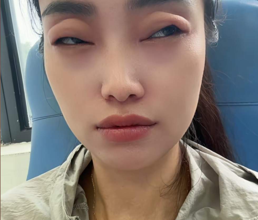 2颗下肚！女子眼睛差点看不见了！正大量上市，有人吃到抢救