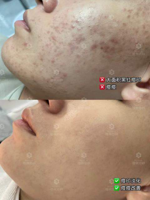 痘印痘坑、增生疤痕久治不愈？福州海峡公益修肤：分层施治，重塑健康肌底