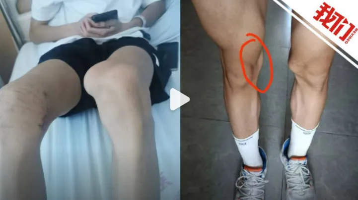 17岁男孩腿部手术，居然左右膝搞错！母亲最新发声