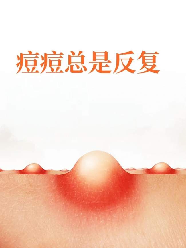 祛痘别只消表面炎症！海峡张光泽研创痘全净：分型分阶，先治痘再重建皮肤屏障