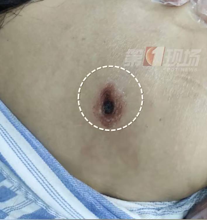 被虫叮一口差点要了命 户外游玩小心这个“小虫子”