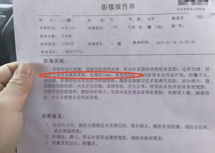 患者术后针头掉进肝脏逾30天，且无法取出？多方回应