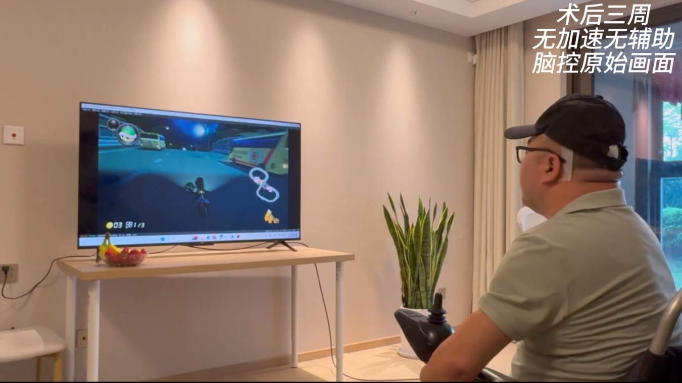 我国成功开展首例侵入式脑机接口临床试验