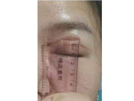 女子做双眼皮手术,结果有12毫米宽!绷不住了:朋友说我像“悲伤蛙”