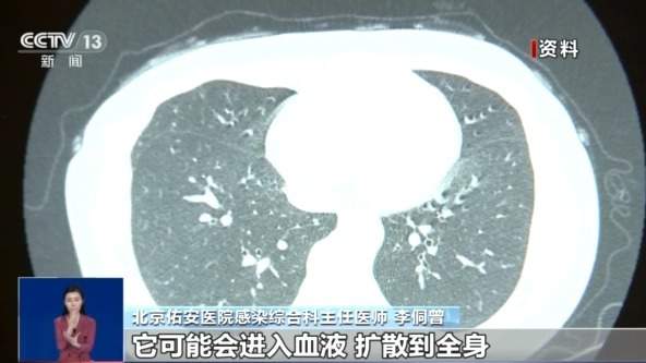 女孩脑部被真菌侵蚀出现“空洞”？大扫除要警惕霉变粉尘！