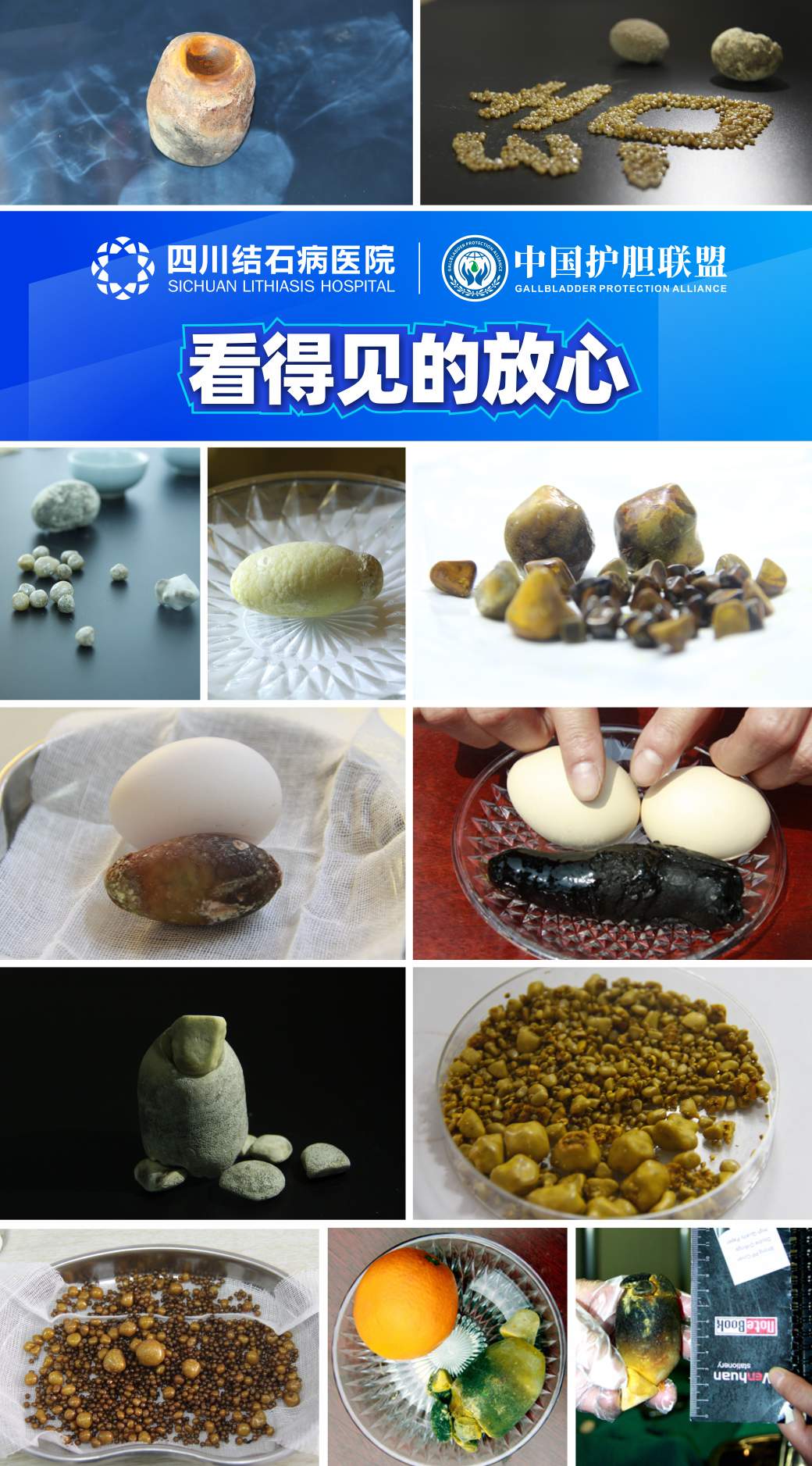 胆囊健康科普宣传周：胆囊健康日义诊义检，四川结石病医院在行动  