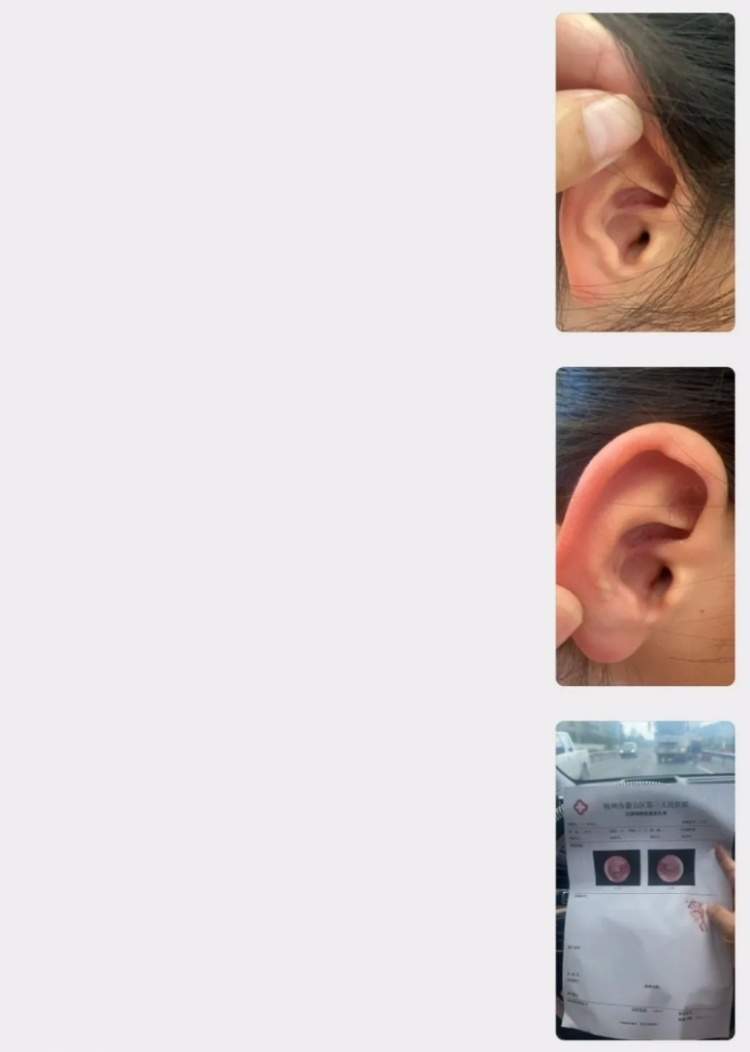 太可怕了！男孩去水上乐园玩水感染传染性软疣 