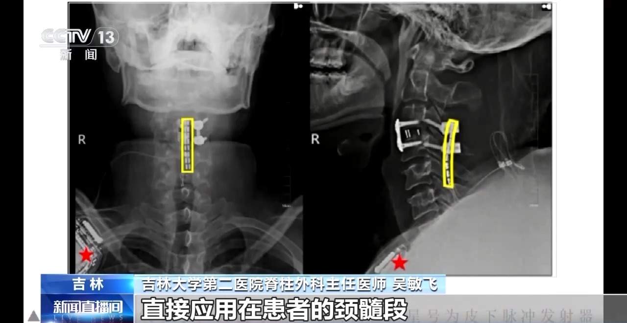让高位截瘫患者自主行走 我国脊髓神经接口技术应用再获突破
