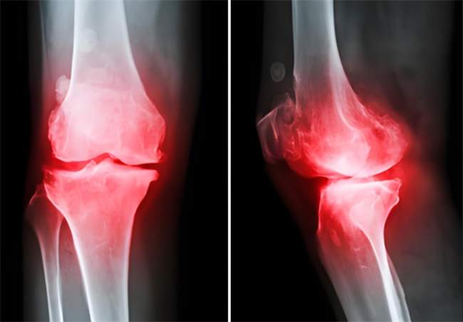 氨糖软骨素钙片能治疗骨关节炎吗？这篇深入讲解！