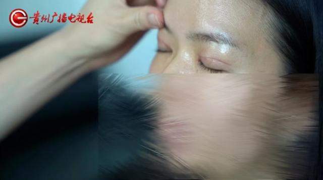 女子做双眼皮手术,结果有12毫米宽!绷不住了:朋友说我像“悲伤蛙”