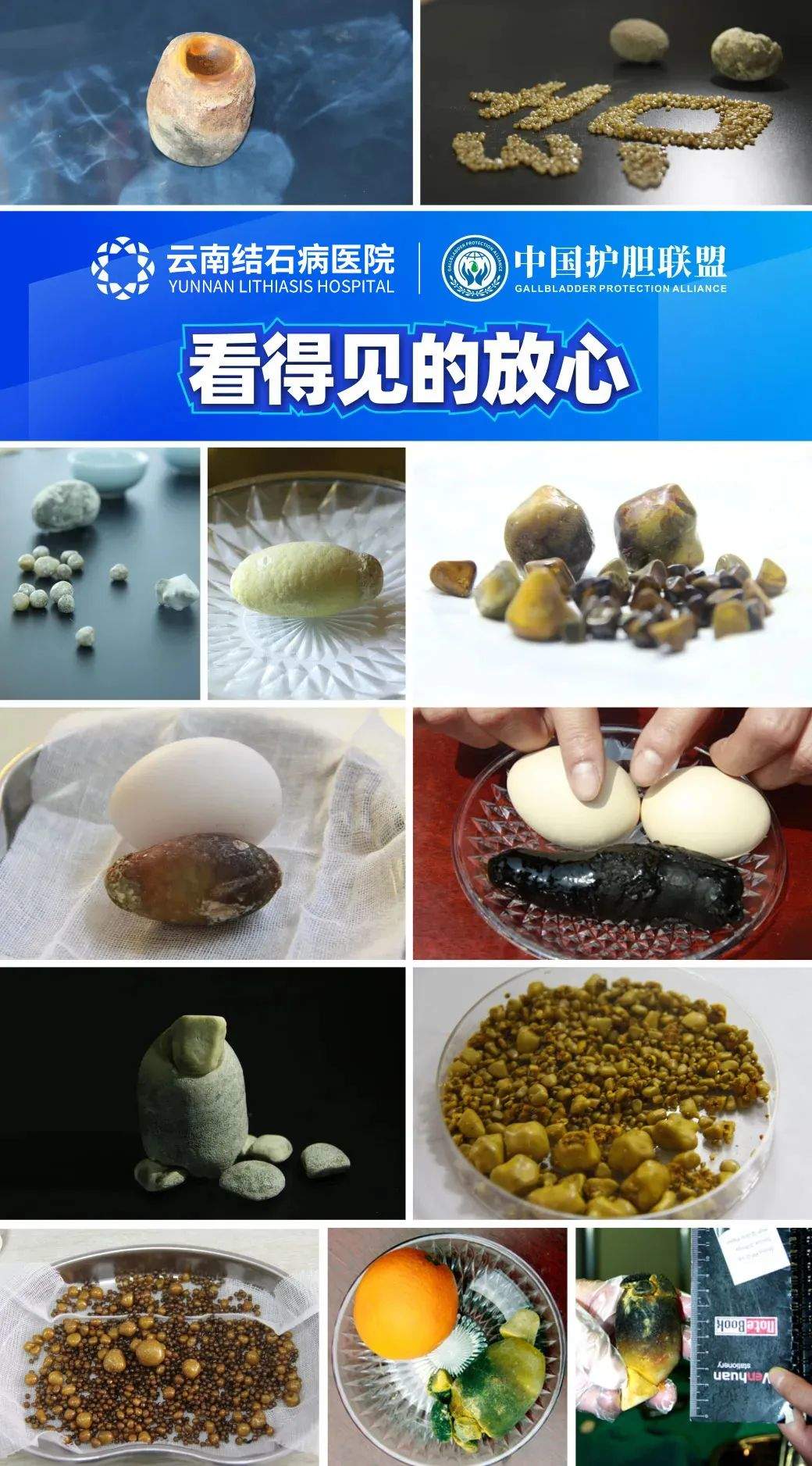 云南胆结石案例：昭通女士小结石不管，结石掉入胆总管遗憾切胆