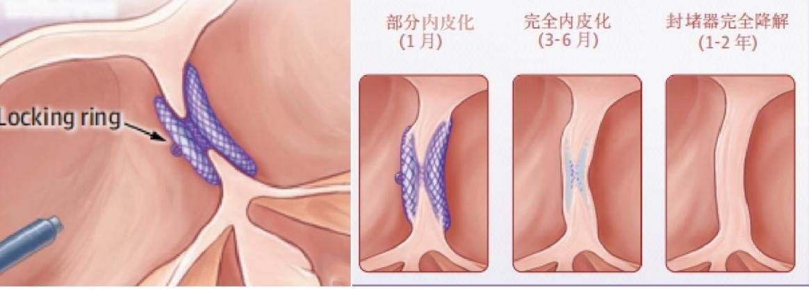 可降解封堵器，让先心家长告别背后焦虑