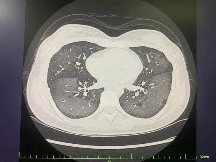 20岁女孩突然查出“白肺”!元凶太常见
